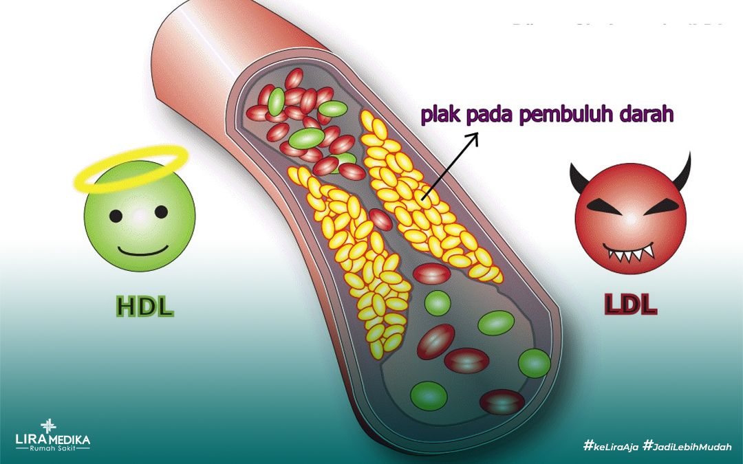 Memahami Kolesterol Jahat